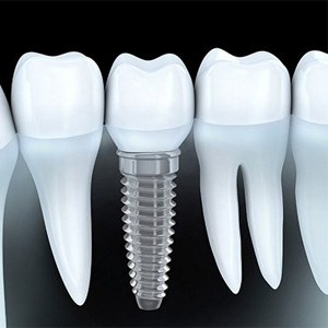 a model of a single dental implant