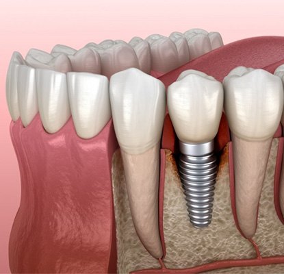 a 3D depiction of a dental implant in the jawbone